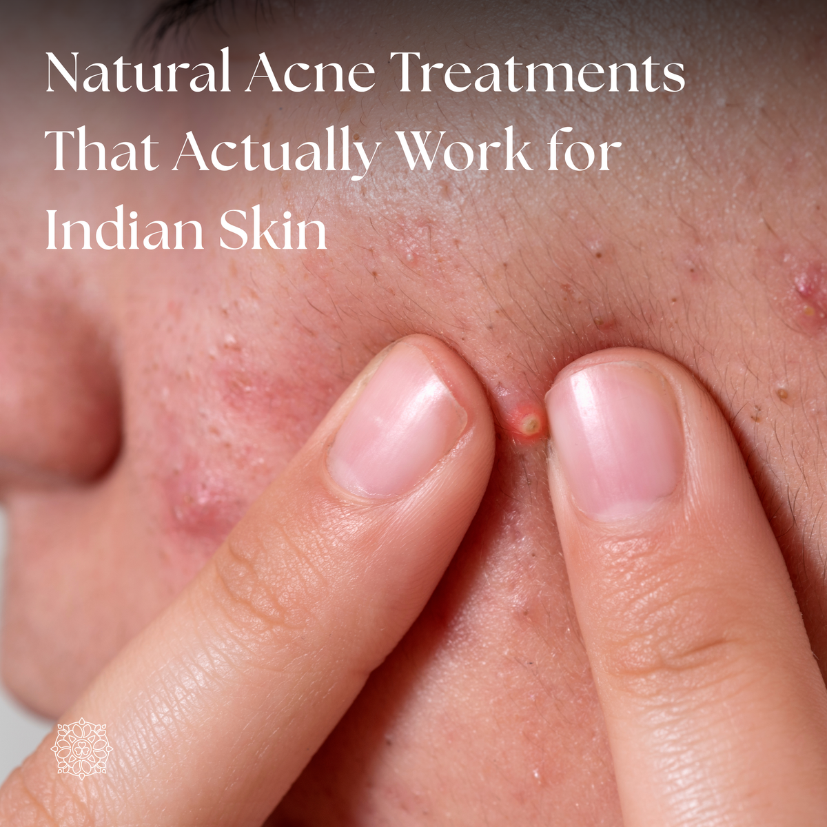 Natural Acne Treatments That Actually Work for Indian Skin – INRIA